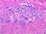 Figure 11  Chronic inflammatory cells were noted beneath the mucosal layer.