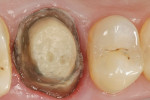 Figure 2  Clinical view after removal of crown, composite buildup, and modifying existing preparation.