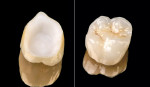 Figure 3  Completed all-ceramic crown, fabricated with a zirconium internal substructure and Vita® VM-9 surface ceramics (Vident, Brea, CA).