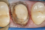 Figure 5  The preparation was isolated for the cementation procedure, and cleaned with 2% chlorhexidine, rinsed, and air-dried.