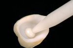 Figure 6  Application of a self-etch cement (Breeze) onto the internal aspects of the porcelain crown for final cementation.