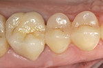 Figure 8  Postoperative occluso-buccal view of the final restoration. Note the bioesthetic integration at the restorative interface.