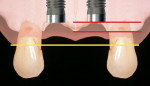 Figure 3  When adjacent implants are placed 3 or more millimeters apart and the interproximal crest of bone is retained (red line), the papilla between the implants may be within 1 to 1.5 mm of the original papilla height (yellow line).
