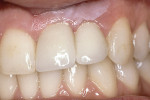 Figure 11  At time of placement of final restoration, soft tissue levels are acceptable.