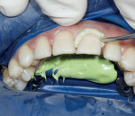 Figure 16  Using Expasyl for slight gingival retraction before adhesive bonding of the veneers.