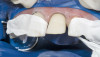 Fig 4. A denture base is milled.