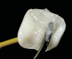Figure 20  Placing resin cement into the onlay that is being held by the bonded composite nylon brush.