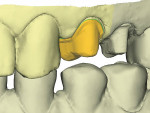 Figure 5  A digital model from the Cadent scan.