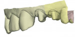 Figure 6  A digital model from the Cadent scan.