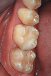 Figure 1 View of the patient's preoperative condition demonstrating the need for updated restorations on the posterior teeth.