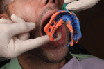 Figure 6 After setting, the impression was removed from the patient's mouth.