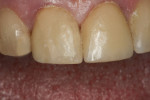 Figure 9 The thickness of the ceramic repair is 95% UD4 dentin, with a 5% thickness layer of UE2 enamel.