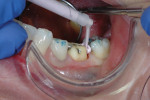 Figure 2 Digital power Dispenser and Aquasil Ultra Cordless Tissue Managing Impression single-unit wash material being used to capture a final impression for tooth No. 19. Buccal retracted view.