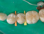 Figure 1b  Class 2 cavity preparation.