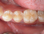 Figure 1c  Restoration using a self-etch adhesive with a micromatrix hybrid composite resin.
