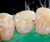 Figure 16 First-phase implants loaded with conical abutments and, in some cases, their angulated counterparts.