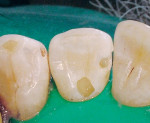 Figure 2b  Class 3 and lingual cavity preparations.