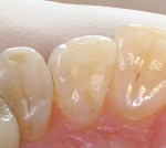 Figure 2c  Restorations using a self-etch adhesive with a microfill hybrid composite resin.