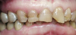 Figure 1  Anterior view demonstrates deep overbite, discolored teeth, and chipped incisal edges.
