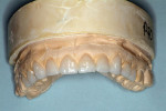 Figure 4  Wax-up of potential restorations demonstrates the possible esthetics that could be achieved.