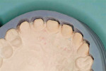 Figure 5  Putty preparation guide used to verify reduction of the six anterior teeth.