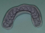 Figure 8  Putty impression of the wax-up is used to fabricate the provisional restorations.