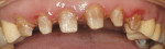 Figure 9  The teeth are prepared and a stumpf shade is taken.