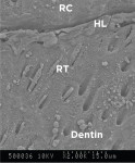 Figure 1 through Figure 3. Cross sections of evaluated restorative materials at the resin/dentin interfaces displaying resin composite (RC), resin tag (RT), hybrid layer (HL), and dentin. Group 1 (DBC-ER) under 2000x magnification (Fig 1); Group 2 (DBC-SE) under 3000x magnification (Fig 2); Group 3 (SBC-SE) under 3000x magnification (Fig 3).