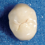 Figure 10  Occlusal view of the final premolar restoration demonstrating the color and detail that can be incorporated.