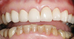 Figure 12  The final esthetic result in the maxillary arch demonstrates incisal translucency but masks the dark teeth underneath.