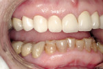Figure 13  Right lateral view demonstrates excellent gingival adaptation.