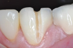 Figure 2 Facial view of the cuts made first
through the layering porcelain, and then through the zirconia coping. This was carefully done to avoid/minimize damage to the underlying natural tooth structure.