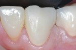 Figure 6 Facial view of the provisional restoration, after 1 week. The healing of the gingival tissues around the provisional was noticeable.