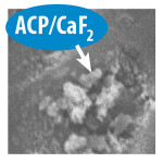 Figure 2. SEM showing amorphous calcium phosphate (ACP) and calcium-fluoride (CaF) deposits occluding tubules.