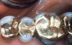 Figure 5 Maxillary gold restorations (left).