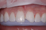 Figure 2 A matrix can be fabricated from the diagnostic wax-up or intraoral mock-up that captures the intended lingual, incisal, and proximal contours of the restoration.