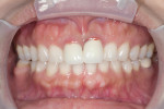 Figure 1 Porcelain-fused-to-metal crowns on tooth No. 8 and No. 9 that will be replaced with BruxZir® Solid Zirconia.