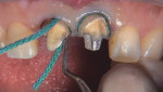 Figure 3 Packing cord on tooth No. 8 and No. 9.