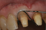 Figure 5 A non-impregnated #2-0 braided surgical suture was placed to expose 0.5 mm of tooth structure.