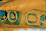 Figure 10  After tooth preparation for a fixed three-unit bridge, a master impression was made. Note the 360° “cuff” around the margins.