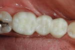 Figure 11  The three-unit provisional was cemented to place from the occlusal aspect.