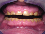 Figure 1 Severe occlusal wear on a patient (aged mid-40s) , which caused severe pain and impaired function.