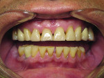 Figure 2 In this patient, severe wear accompanied extreme muscle pain and history of multiple fractures leading to tooth loss.