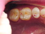 Figure 4 First maxillary molar with severe pain associated to occlusal trauma.