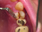 Figure 5 Fractured bicuspid on a patient with a history of fracturing teeth and multiple implant replacements.