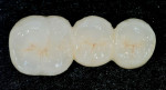 Figure 14  The ceramic restoration shown from the occlusal view. Note how the design of the provisional restoration is replicated in the ceramics.