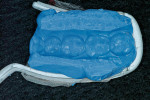 Figure 15  A disposable triple tray with VPS bite registration material was used to make a provisional stent for teeth Nos. 29 and 30. This technique is acceptable for stent fabrication as long as tooth contour and position is ideal.