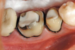Figure 16  An occlusal view of prepared teeth Nos. 29 and 30. Glass ionomer bases were placed in excavated areas. #00 braided retraction cord remained in the sulcus after removal of the #1 cord before making the master impression.