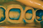 Figure 17  The master impression for teeth Nos. 29 and 30.