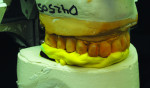 The mandibular based jig is now mounted to maxillary facebow mount with dental plaster.